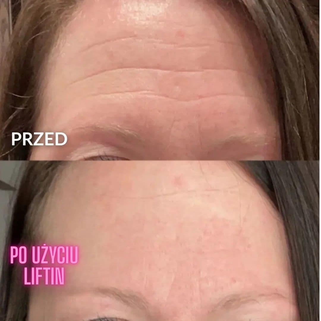 Zestaw Liftin - Plastry medyczne usuwające zmarszczki | Wielokrotnego użytku (5 szt.)