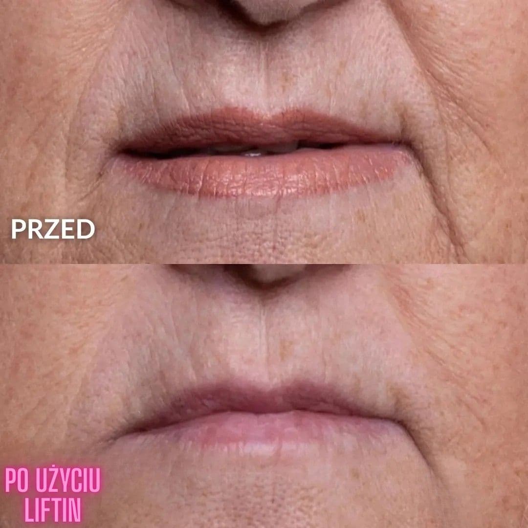 Zestaw Liftin - Plastry medyczne usuwające zmarszczki | Wielokrotnego użytku (5 szt.)